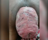 Thrombosed External Haemorrhoid