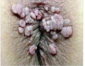 Thrombosed External Haemorrhoid