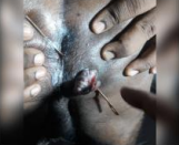 Thrombosed External Haemorrhoid