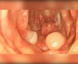 Thrombosed External Haemorrhoid