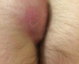 Thrombosed External Haemorrhoid