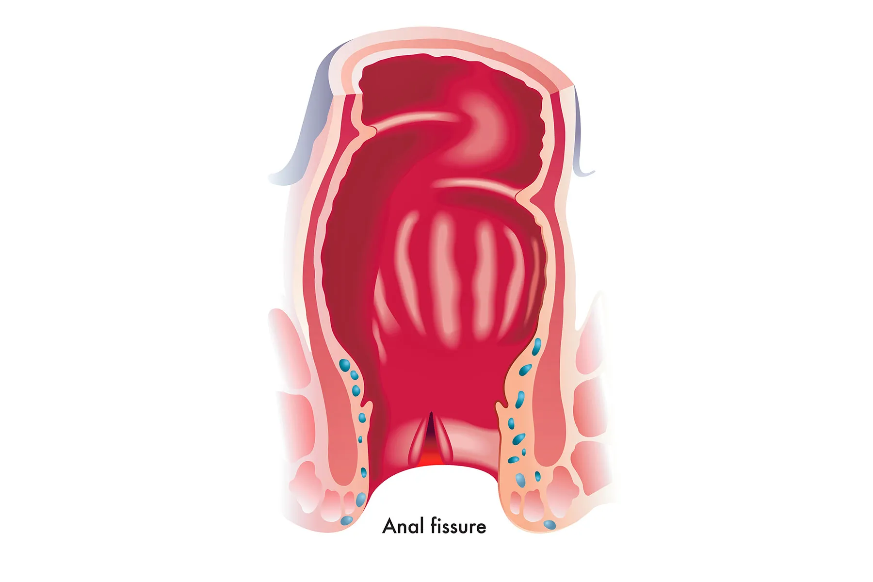 Fissure